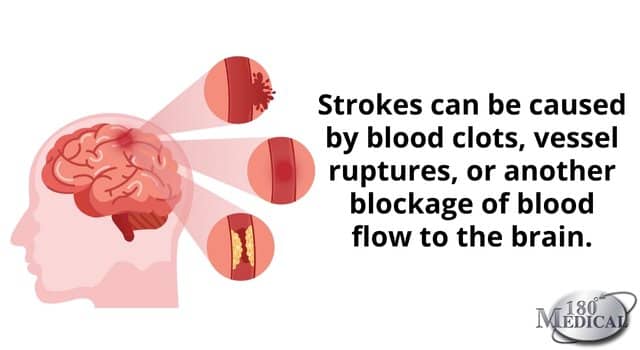 strokes can be caused by clots, vessel ruptures, or blockages