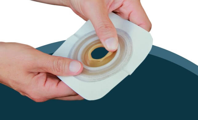 hands demonstrating moldable technology ostomy wafer