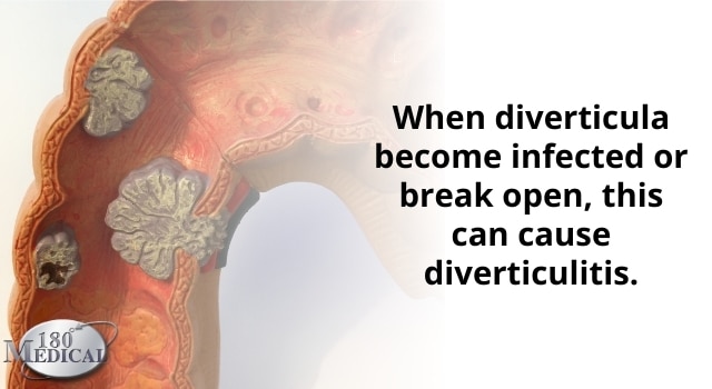 diverticulitis is caused by infected sacs in the colon