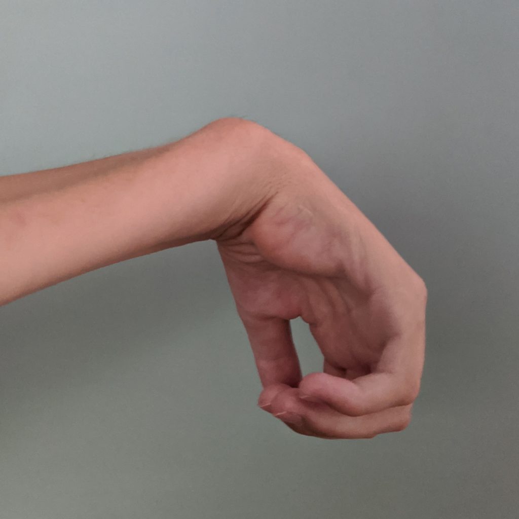wrist flexion tenodesis