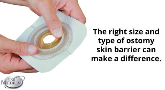 the right size and type of skin barrier can make a difference in ostomy leakage