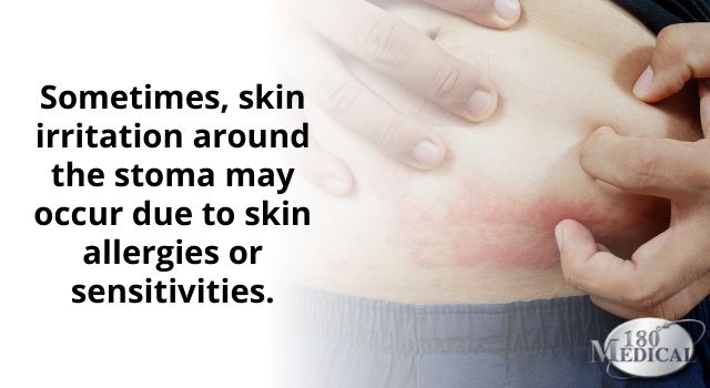 Peristomal skin complications could be due to an allergy or sensitivity