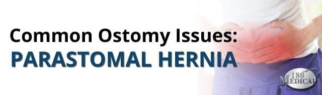 Common Ostomy Issues, parastomal hernia