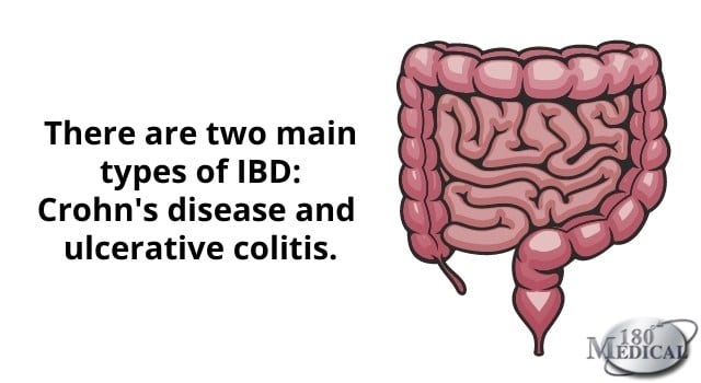 The two types of IBD are crohn's disease and ulcerative colitis