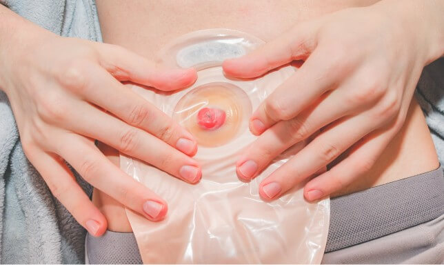healthy stoma with hands holding ostomy bag